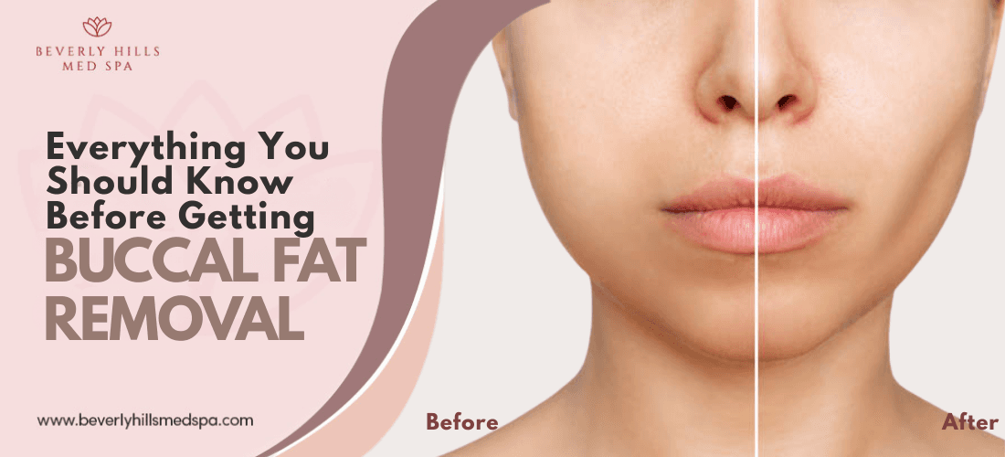 buccal fat removal